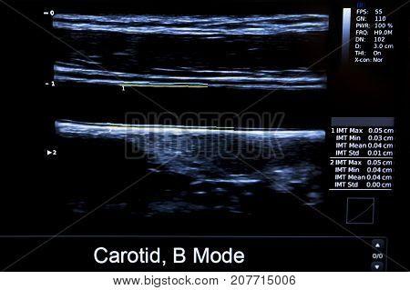 Colourful Image Of Homan Heart Ultrasound Monitor