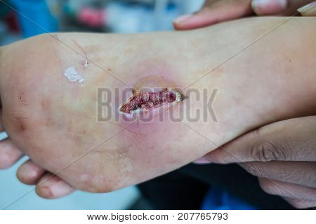 closeup  infection wound in the foot of patients .