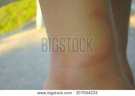 Bte Of Jellyfish. Jelly Fish Marks On The Human Body