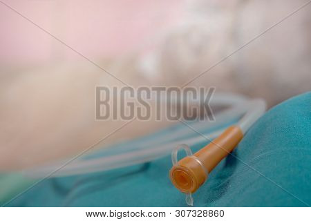 Nasogastric Tube Feeding.insert A Nose To Feed The Patient.