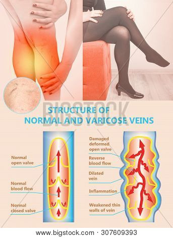 Varicose Vein On A Female Senior Legs. The Structure Of Normal And Varicose Veins. Concept Of Dry Sk