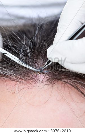 Doctor Removing Stitches With A Pincette And Scissors, Wound Suture On A Man ´s Forehead, Closeup