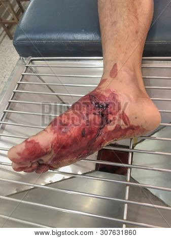 Blurred Images Of Wound On The Feet Of Male Patients That Has Been Cut With Sharp Objects. Patients 