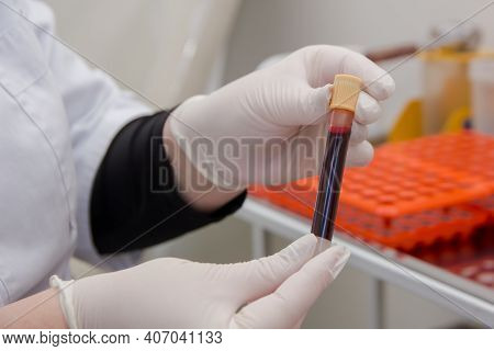The Doctor Holds A Vacutainer With Human Blood.