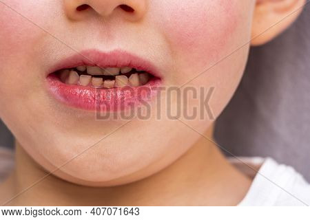Child Loose Tooth. Little Boy 6 Years Old Loose Baby Tooth Incisor. Kids Dental Medicine And Oral Hy