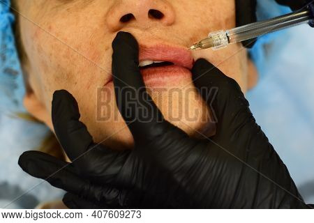 Closeup Woman Lips, Procedure Augmentation. Syringe Female Mouth, Hyaluronic Acid Injection, Augment