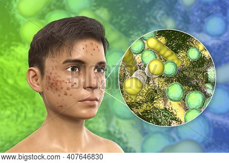 Acne, Pimples, And Closeup View Of Bacteria, The Causative Agents Of Skin Lesions