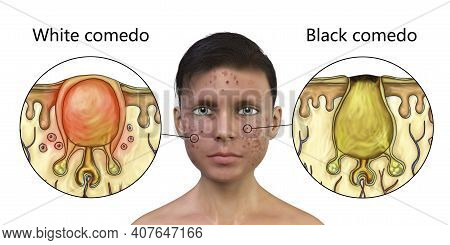 Acne Vulgaris In A Teenager Boy, White And Black Comedo