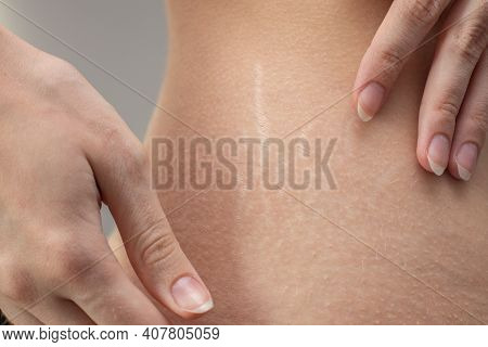 Woman Hips With Visible Stretch Marks. Young Woman Showing Stretch Mark Scars On Her Body.