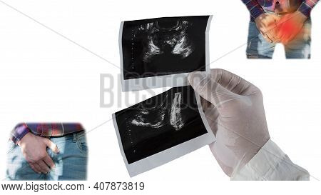 Male Prostate, Pain In The Urogenital Canal, The Doctor Analyzes The Ultrasound Of The Prostate, The