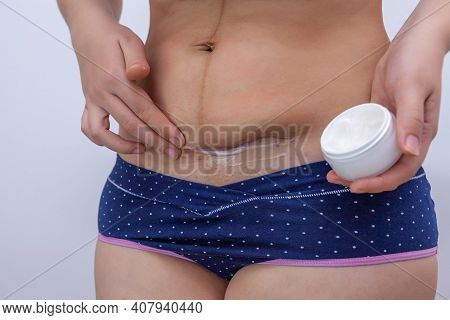 A Woman After Giving Birth Smears Ointment On The Scar From A Caesarean Section
