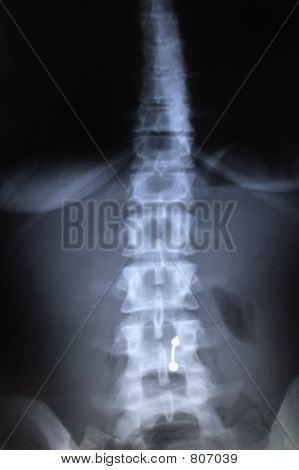 Spine Radiography - X Rays