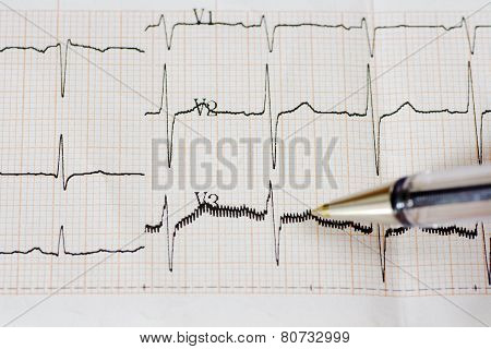 Arrhythmia