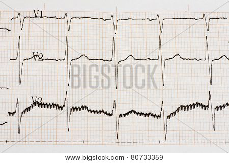 Arrhythmia
