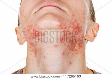 Young Girl With Skin Problem