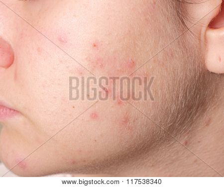 Acne on the girl's face