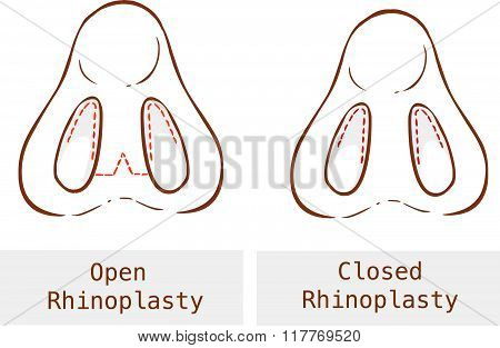 Vector Illustration Of A Anatomy Rhinoplasty Technique