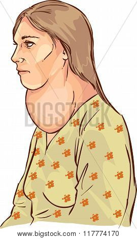 White Backround Vector Illustration Of A Goiter