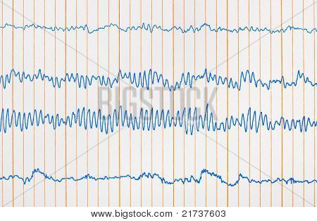 심전도 Ecg