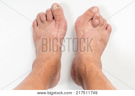 Feet of a woman with advanced stage bunion (Hallux abductus valgus)