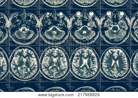 Computer tomography X-Ray brain scan image, internal hydrocephalus, neurology concept