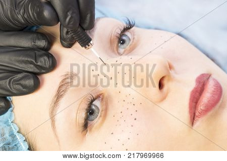 Permanent microblasting tattooing freckles to a woman in a beauty salon