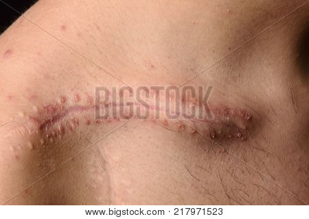 Detail Of A Scar On The Clavicle