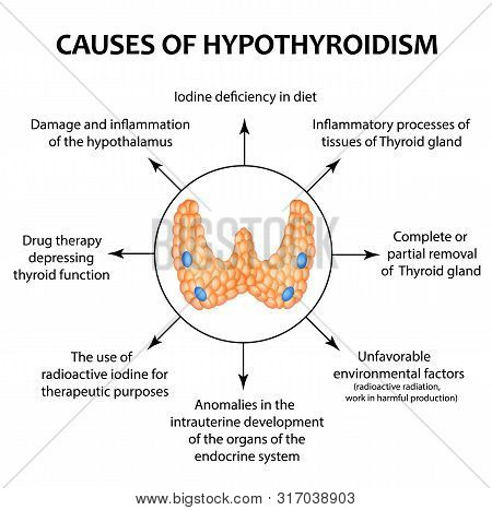 The Causes Of Thyroid Hypothyroidism. Infographics. Illustration On Isolated Background.