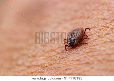 Tick Filled With Blood Sitting On Human Skin.