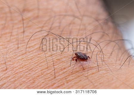 Tick Filled With Blood Sitting On Human Skin.
