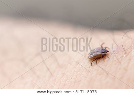 Tick Filled With Blood Sitting On Human Skin.