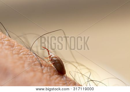 Tick Filled With Blood Sitting On Human Skin.