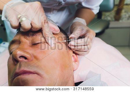 Close-up Of Procedure For Face Lifting Pdo Suture Operation, Face Lifting Surgery. Innovative Techni