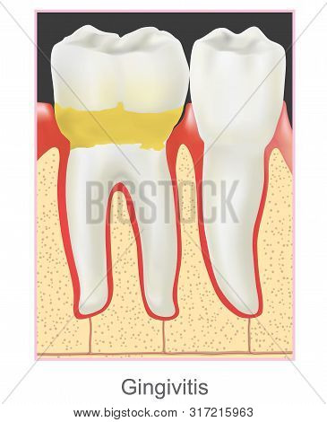 Dental Calculus Is The Calcified Plaque, Or Tartar, That Is Removed With A Dental Scalar During Regu