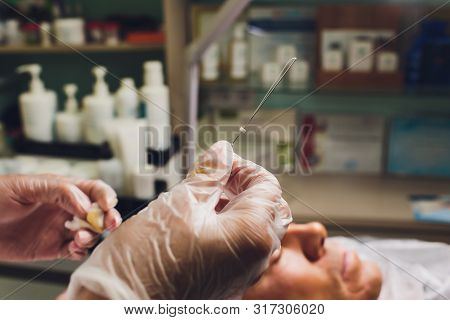 Close-up Of Procedure For Face Lifting Pdo Suture Operation, Face Lifting Surgery. Innovative Techni