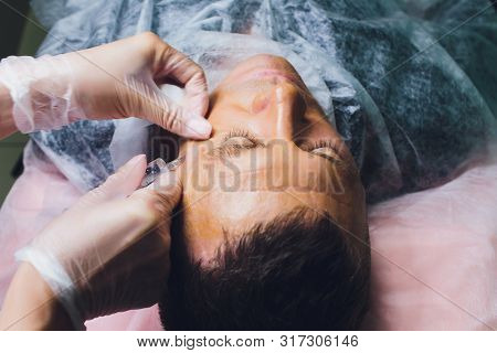Close-up Of Procedure For Face Lifting Pdo Suture Operation, Face Lifting Surgery. Innovative Techni