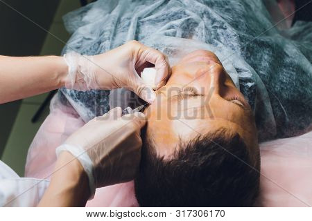 Close-up Of Procedure For Face Lifting Pdo Suture Operation, Face Lifting Surgery. Innovative Techni