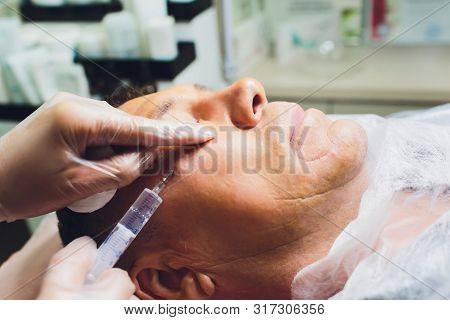 Close-up Of Procedure For Face Lifting Pdo Suture Operation, Face Lifting Surgery. Innovative Techni