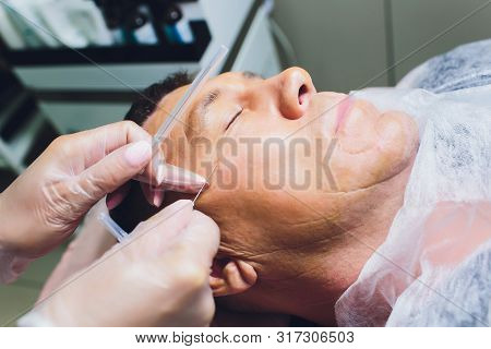 Close-up Of Procedure For Face Lifting Pdo Suture Operation, Face Lifting Surgery. Innovative Techni