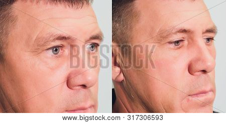 Close-up Of Procedure For Face Lifting Pdo Suture Operation, Face Lifting Surgery. Innovative Techni