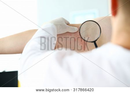 Male Doctor In White Protective Gloves Hold Magnifying Glass. Examines Patient With Skin Disease Aga