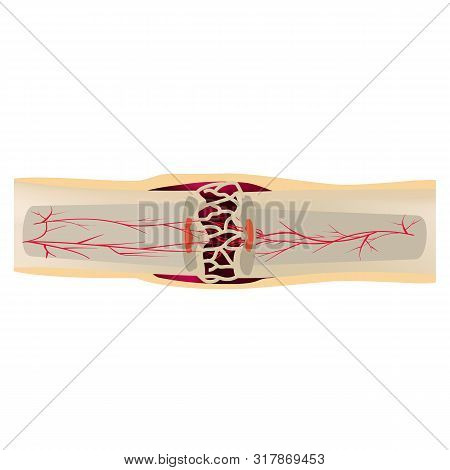 3 Stage Of Healing Bone Fracture. Callus Ossification. The Bone Fracture. Infographics. Illustration