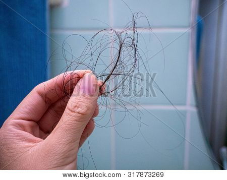 Uman Hand With Lost Hair On It, Isolated On White Background.