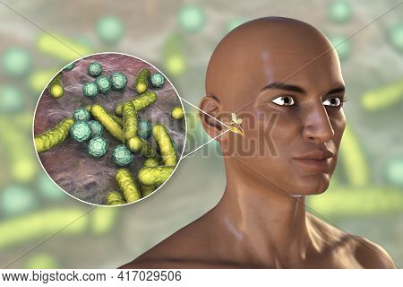 Otitis Media, Inflammatory Disease Of The Middle Ear, 3d Illustration Showing An African Man With Hi