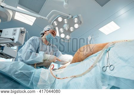 Cosmetic Liposuction Surgery In Actual Operating Room Setting Showing Surgeons Group During Operatio