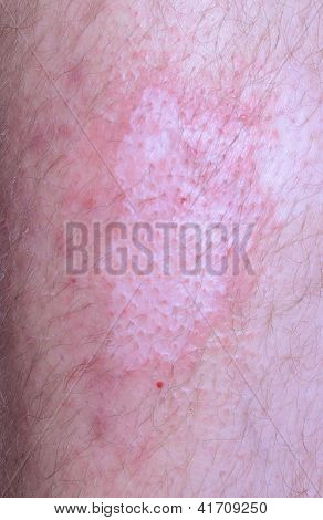 Infected Psoriasis
