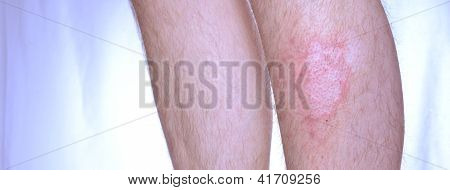 Vitiligo