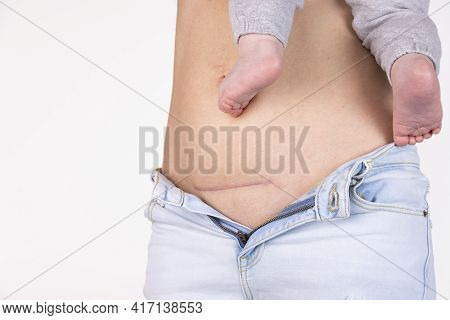 Close-up Of A Woman's Belly With A Cesarean Section Scar, Five Months After Giving Birth. Woman With