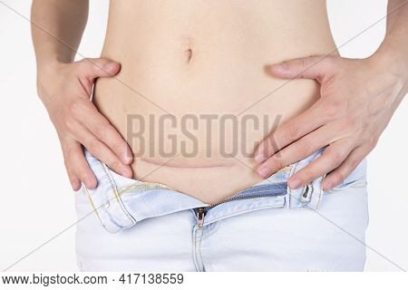 Woman's Belly With A Scar After Cesarean Section, Childbirth. Five Months After Surgery.
