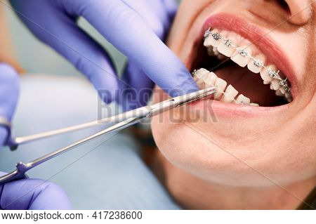Close Up Of Orthodontist Hands In Blue Gloves Using Dental Forceps While Putting Ligature Wire On Fe